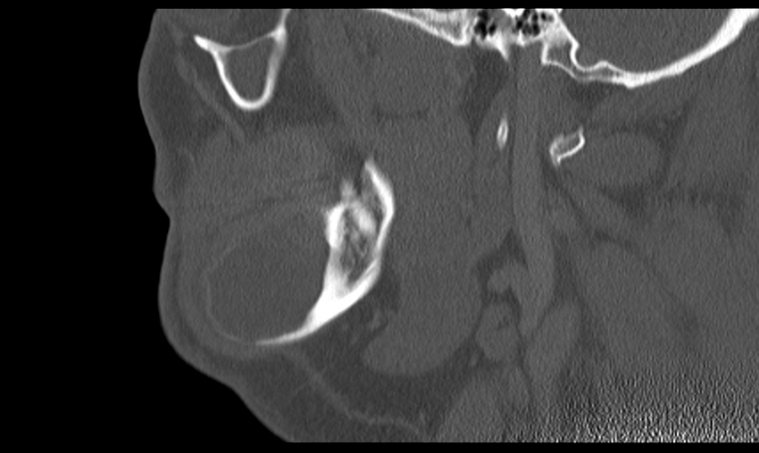 Ameloblastoma (Radiopaedia 33677-34806 Sagittal bone window 21).png