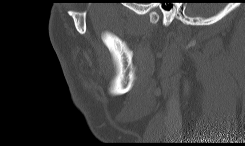 File:Ameloblastoma (Radiopaedia 33677-34806 Sagittal bone window 47).png