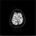 Amnestic syndrome secondary to hypoxic brain injury (Radiopaedia 24743-25004 DWI 61).jpg