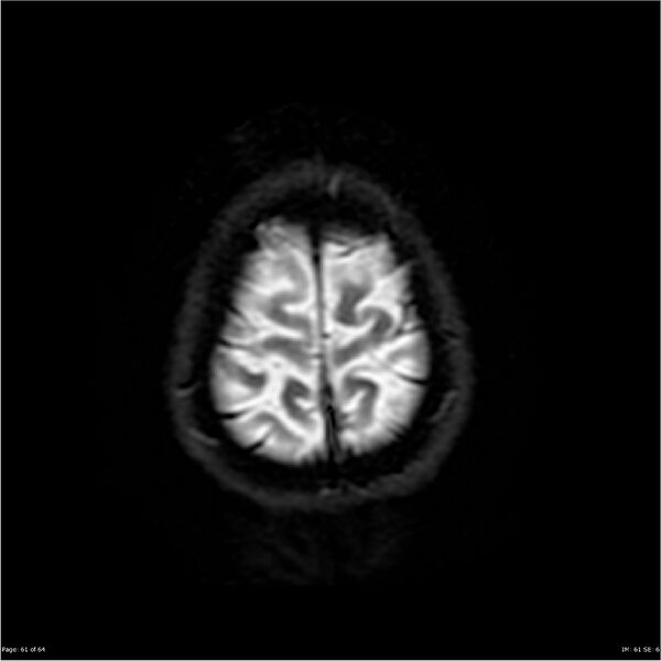 File:Amnestic syndrome secondary to hypoxic brain injury (Radiopaedia 24743-25004 DWI 61).jpg