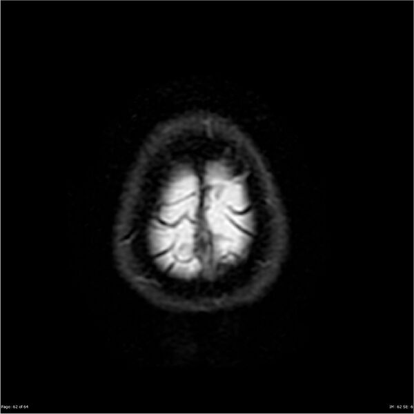 File:Amnestic syndrome secondary to hypoxic brain injury (Radiopaedia 24743-25004 DWI 62).jpg