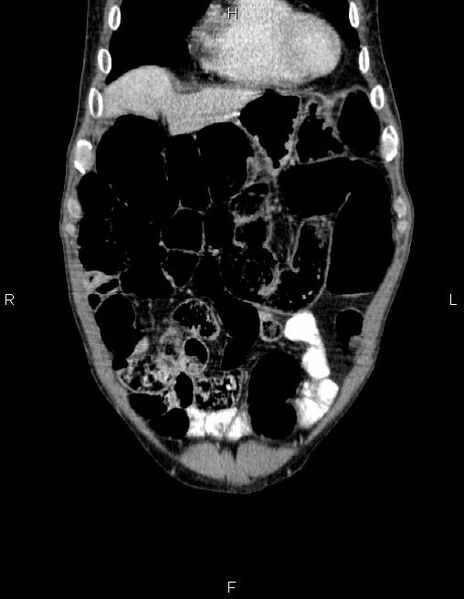 File:Ampullary adenocarcinoma (Radiopaedia 86093-102032 C 11).jpg