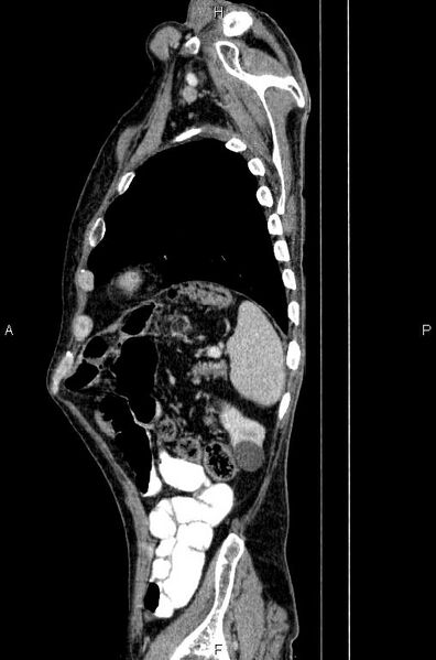File:Ampullary adenocarcinoma (Radiopaedia 86093-102033 E 77).jpg