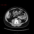 Ampullary carcinoma (Radiopaedia 56396-63056 C 58).jpg