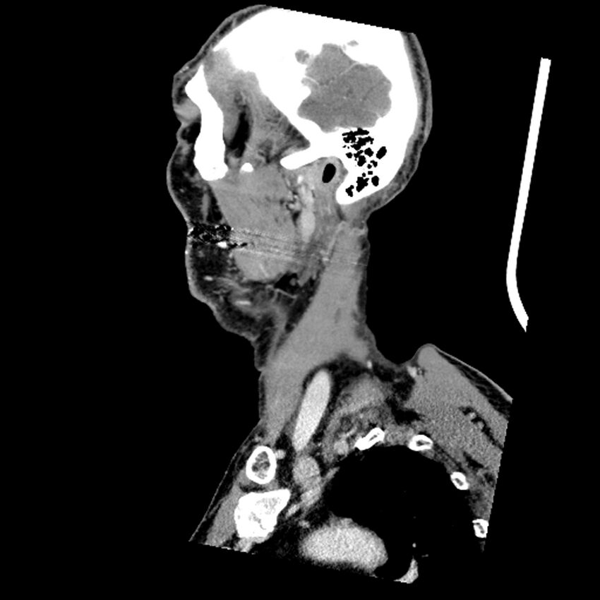 Anaplastic thyroid carcinoma (Radiopaedia 79087-92034 C 75).jpg