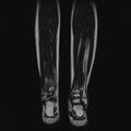 Aneurysmal bone cyst - tibia (Radiopaedia 22343-22367 Coronal T2 13).jpg