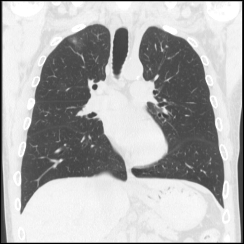Angioinvasive aspergillosis (Radiopaedia 43957-47466 Coronal lung window 50).jpg