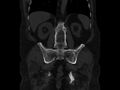 Ankylosing spondylitis (Radiopaedia 44609-48357 Coronal bone window 60).jpg