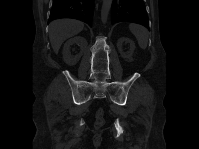 File:Ankylosing spondylitis (Radiopaedia 44609-48357 Coronal bone window 60).jpg