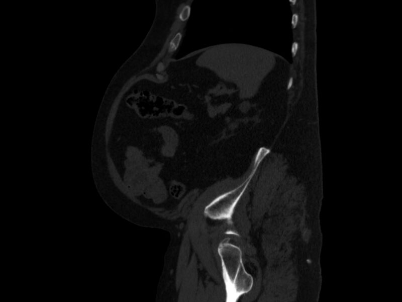 File:Ankylosing spondylitis (Radiopaedia 44609-48357 Sagittal bone window 93).jpg