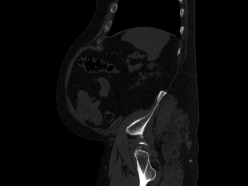 Ankylosing spondylitis (Radiopaedia 44609-48357 Sagittal bone window 93).jpg
