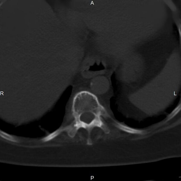 File:Ankylosing spondylitis (Radiopaedia 8748-9556 Axial bone window 6).jpg