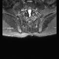 Ankylosing spondylitis with zygapophyseal arthritis (Radiopaedia 38433-40517 D 16).jpg
