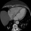 Anomalous origin of left circumflex artery from right coronary sinus (Radiopaedia 72563-83117 A 19).jpg