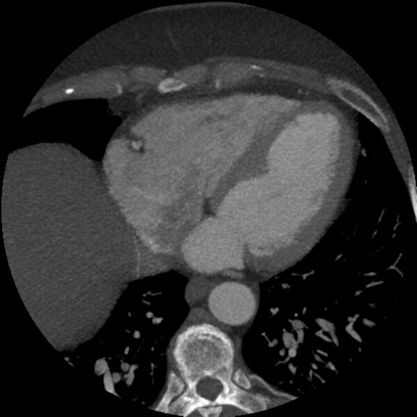 File:Anomalous origin of left circumflex artery from right coronary sinus (Radiopaedia 72563-83117 A 19).jpg