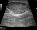 Anterior abdominal wall hematoma (Radiopaedia 11069-11472 B 1).jpg