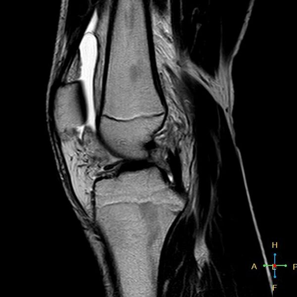File:Anterior cruciate ligament tear - complete (Radiopaedia 24907-25170 Sagittal T2 10).jpg