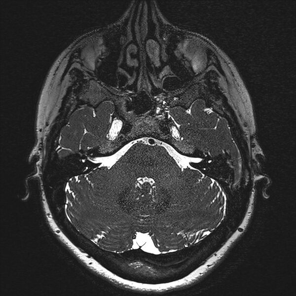 File:Anterior temporal encephalocele (Radiopaedia 82624-96808 Axial T2 high res 21).jpg