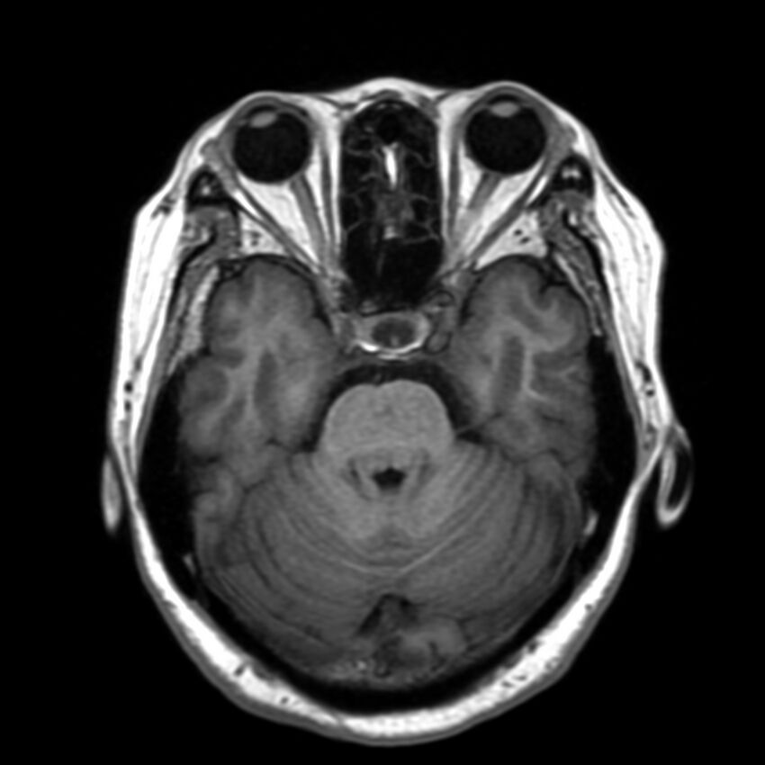 Anti-MOG encephalomyelitis (Radiopaedia 73831-84646 Axial T1 17).jpg