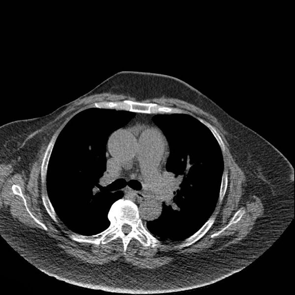 File:Aortic arch false aneurysm (Radiopaedia 14667-14587 Axial non-contrast 21).jpg