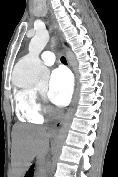 File:Aortic coarctation with aneurysm (Radiopaedia 74818-85828 B 87).jpg