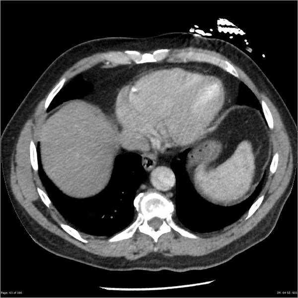 File:Aortic dissection- Stanford A (Radiopaedia 37759-39664 A 54).jpg