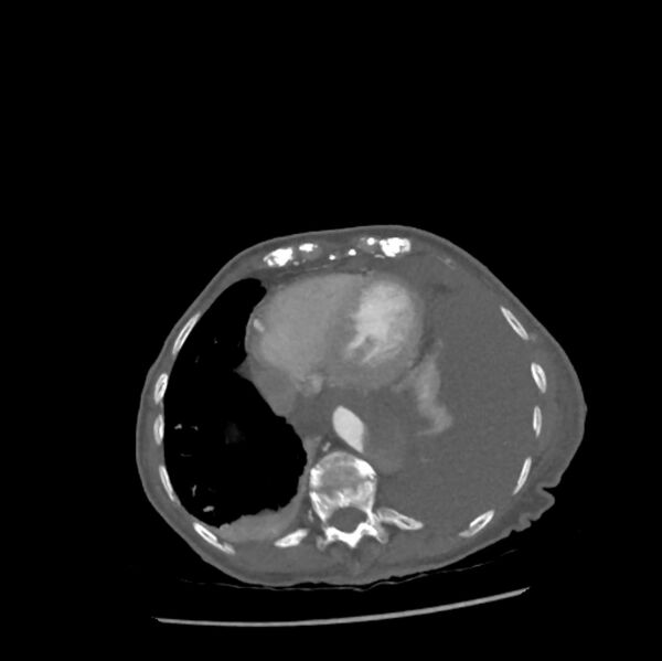 File:Aortic dissection (Radiopaedia 68763-78691 A 44).jpeg