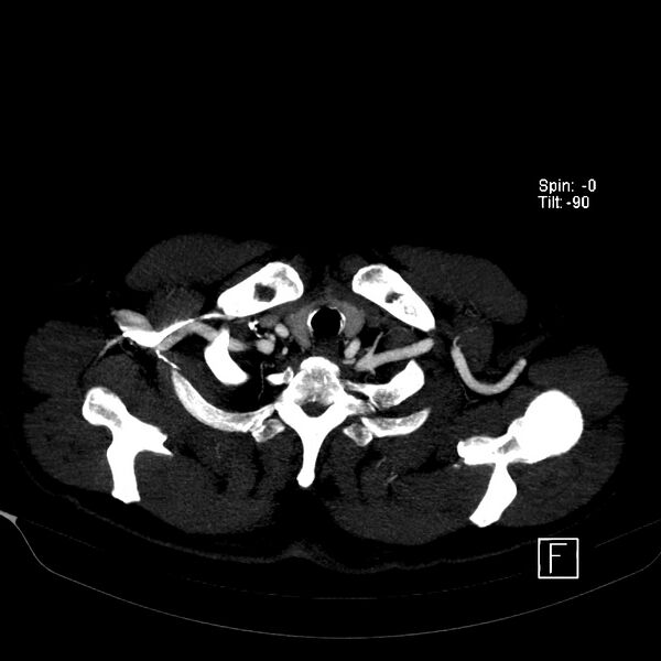 File:Aortic dissection - De Bakey type III - Stanford B (Radiopaedia 21903-21882 B 6).jpg