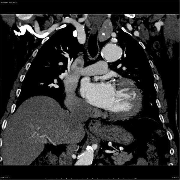 File:Aortic dissection - Stanford type A (Radiopaedia 26183-26315 A 29).jpg