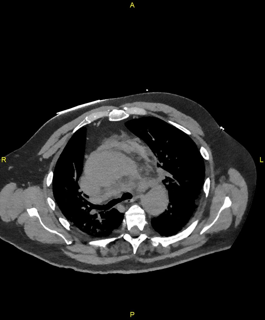 Aortic rupture (Radiopaedia 88822-105594 Axial non-contrast 75).jpg
