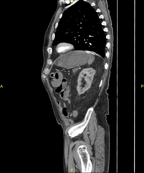 File:Aortoenteric fistula (Radiopaedia 84308-99603 C 267).jpg