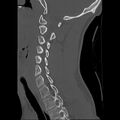 Apical pneumothorax on cervical spine CT (Radiopaedia 45343-49368 Sagittal bone window 11).jpg