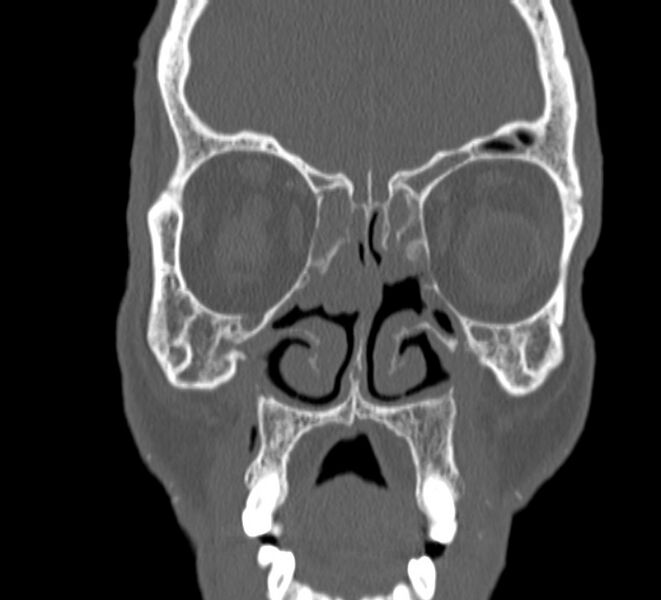File:Aplastic maxillary sinuses (Radiopaedia 60030-67561 Coronal non-contrast 15).jpg