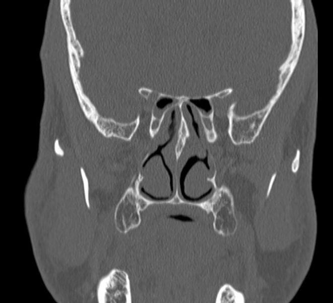 File:Aplastic maxillary sinuses (Radiopaedia 60030-67561 Coronal non-contrast 27).jpg