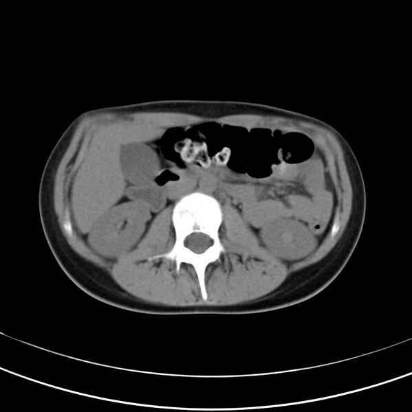 File:Appendicitis and incidental bicornuate uterus (Radiopaedia 22833-22853 Axial non-contrast 19).jpg