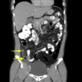 Appendicitis and renal cell carcinoma (Radiopaedia 17063-18402 B 1).png