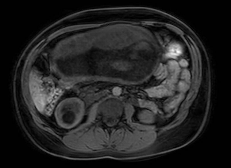 File:Appendicitis in gravida (MRI) (Radiopaedia 89433-106395 Axial DIXON 61).jpg