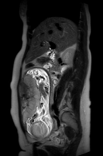 File:Appendicitis in gravida (MRI) (Radiopaedia 89433-106395 Sagittal T2 40).jpg