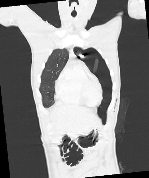 File:Arrow injury to the chest (Radiopaedia 85367-100975 Coronal lung window 49).jpg