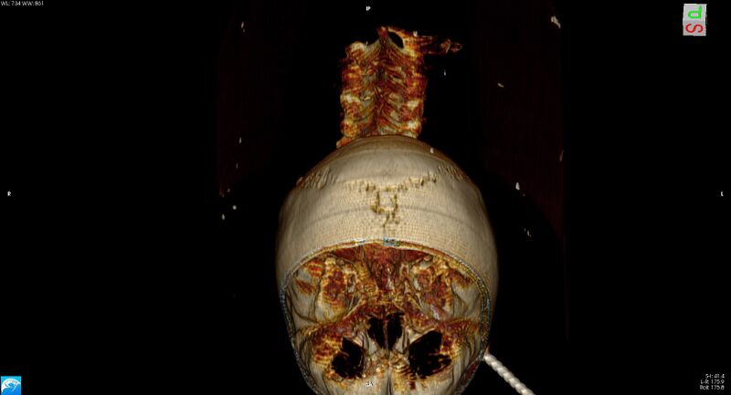 File:Arrow injury to the head (Radiopaedia 75266-86388 3D vertical 32).jpg