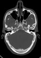 Arrow injury to the head (Radiopaedia 75266-86388 Axial bone window 51).jpg