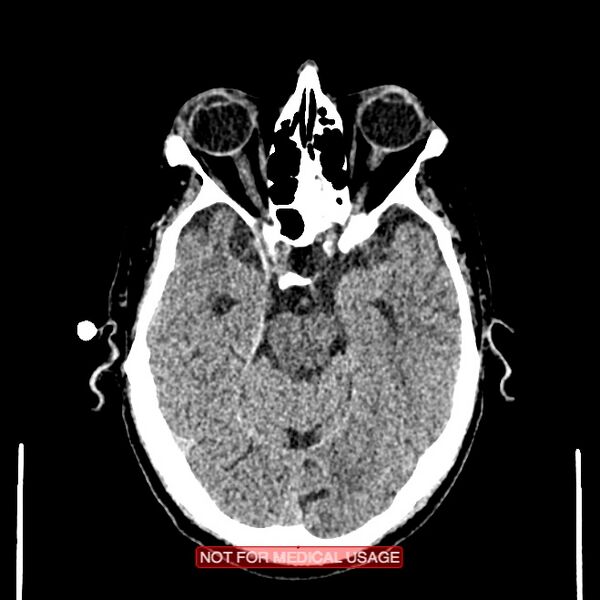File:Artery of Percheron infarction (Radiopaedia 28679-28967 Axial non-contrast 43).jpg