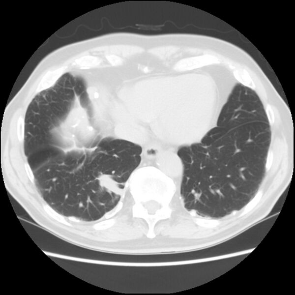 File:Asbestos-related pleural plaques (Radiopaedia 39069-41255 Axial lung window 55).jpg
