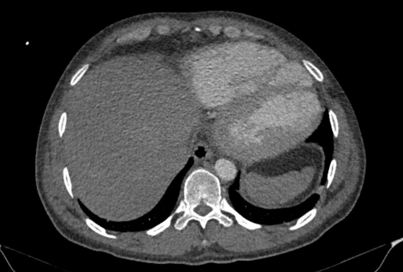 File:Ascending aortic aneurysm (Radiopaedia 86279-102297 C 55).jpg
