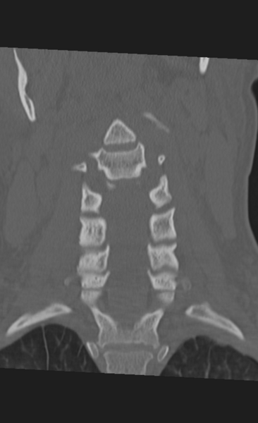 File:Atlanto-occipital dissociation (Radiopaedia 33848-35013 Coronal bone window 19).png