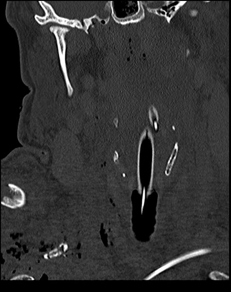 File:Atlanto-occipital dissociation - Traynelis type 1 (Radiopaedia 87570-103948 Coronal bone window 19).jpg