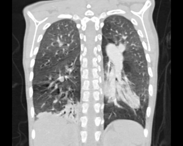 File:Atrial septal defect complicated by Eisenmenger syndrome (Radiopaedia 53707-59768 Sagittal lung window 18).jpg