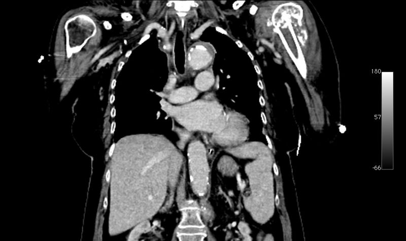 File:Atypical dissection of the thoracic aorta (Radiopaedia 10975-78320 B 19).jpg