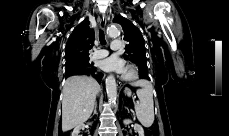 File:Atypical dissection of the thoracic aorta (Radiopaedia 10975-78320 B 21).jpg