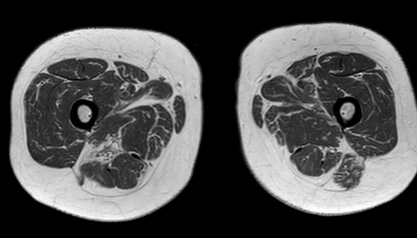Atypical lipomatous tumor - thigh (Radiopaedia 68975-78734 Axial T1 63).jpg